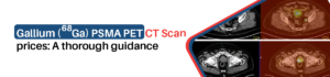 PSMA PET CT Scan Costs in Kolkata: A Guide for Patients